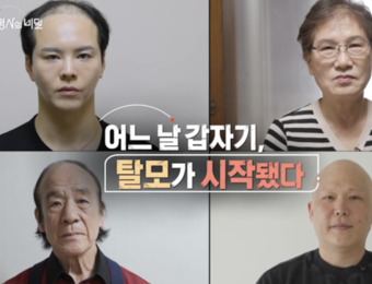 KBS ‘생로병사의 비밀’, 탈모의 원인과 치료 가능성 집중 조명… 5월 6일 방송