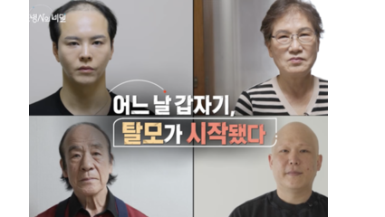 KBS ‘생로병사의 비밀’, 탈모의 원인과 치료 가능성 집중 조명… 5월 6일 방송